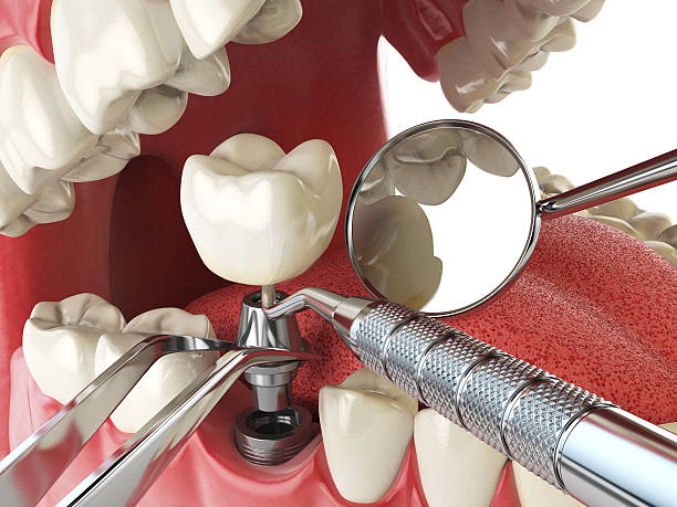 Best Chipped Tooth Repair Near Me  in La Croft, OH